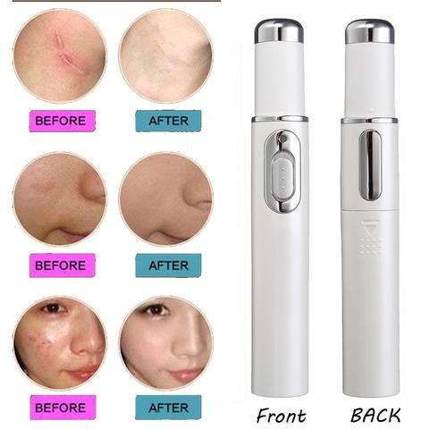 Blue Light Therapy Acne Laser Pen Soft Scar Wrinkle Removal Treatment Device Skin Care Beauty Equipment - MAXXLIFE ONLINE STORE